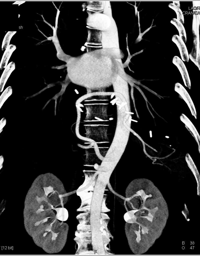 Aortic Repair with Vascular Reconstruction and Mapping - CTisus CT Scan