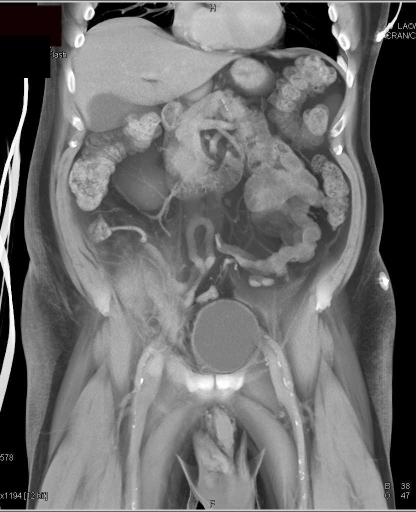 Bleed in Right Lower Quadrant with Superficial Femoral Artery (SFA) Pseudoaneurysm - CTisus CT Scan