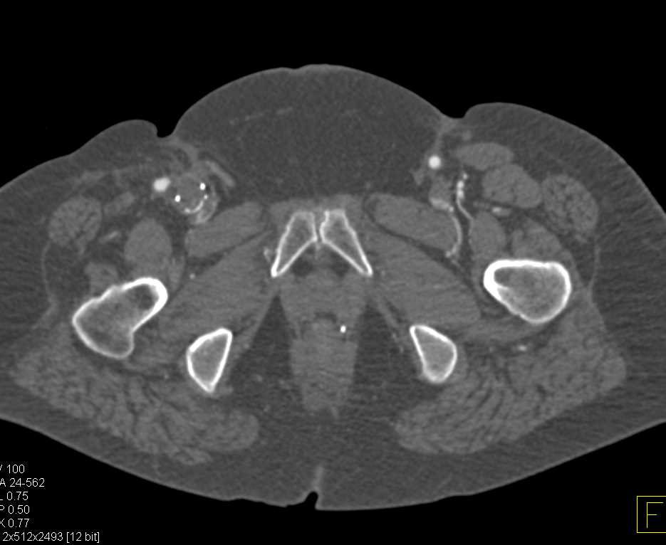 CTA Runoff with Vascular Graft on the Right for Occluded Right Superficial Femoral Artery (SFA) - CTisus CT Scan