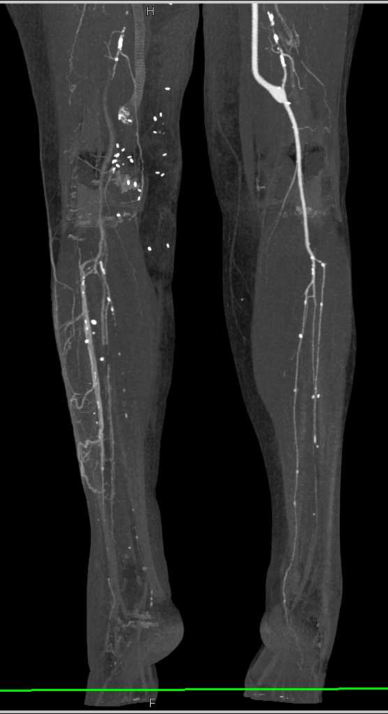 Left Superficial Femoral Artery (SFA) to Popliteal Artery Graft with