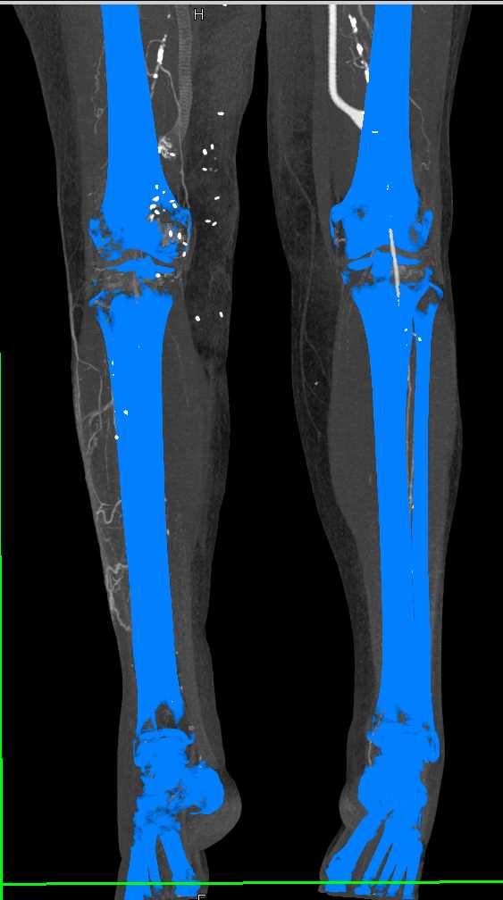 Left Superficial Femoral Artery (SFA) to Popliteal Artery Graft with Occluded Right SFA - CTisus CT Scan