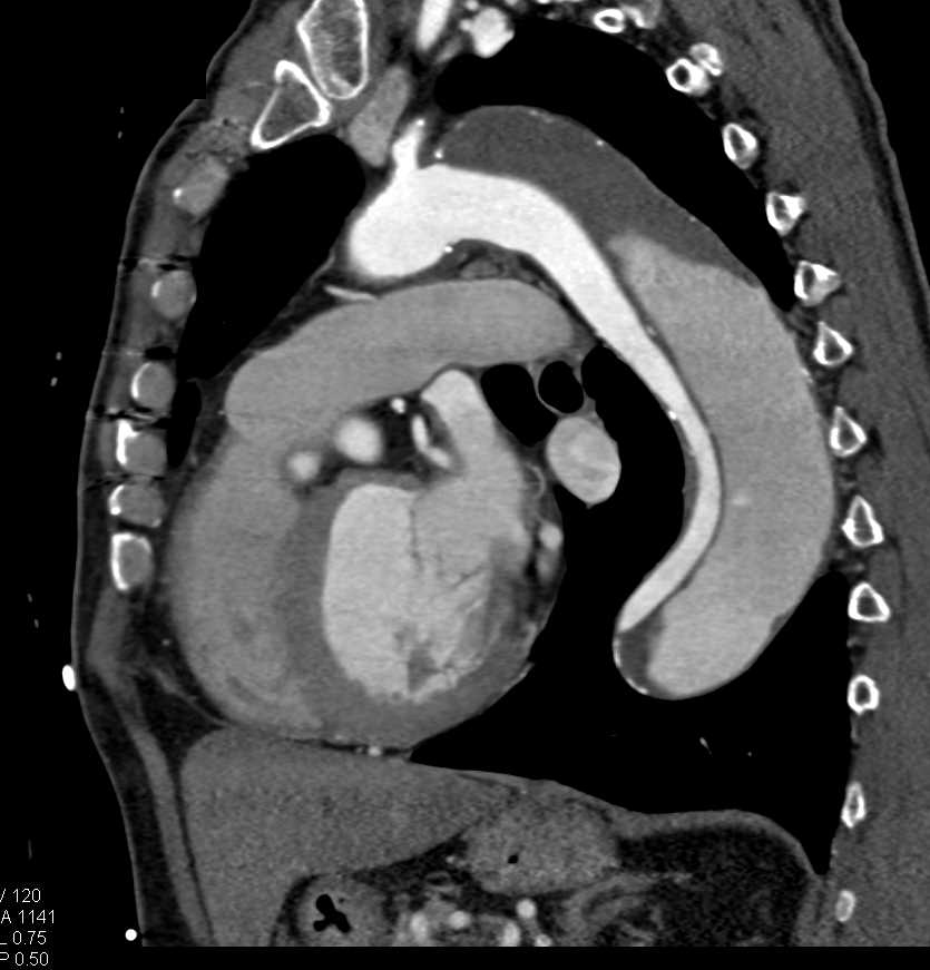 Type B Dissection - CTisus CT Scan