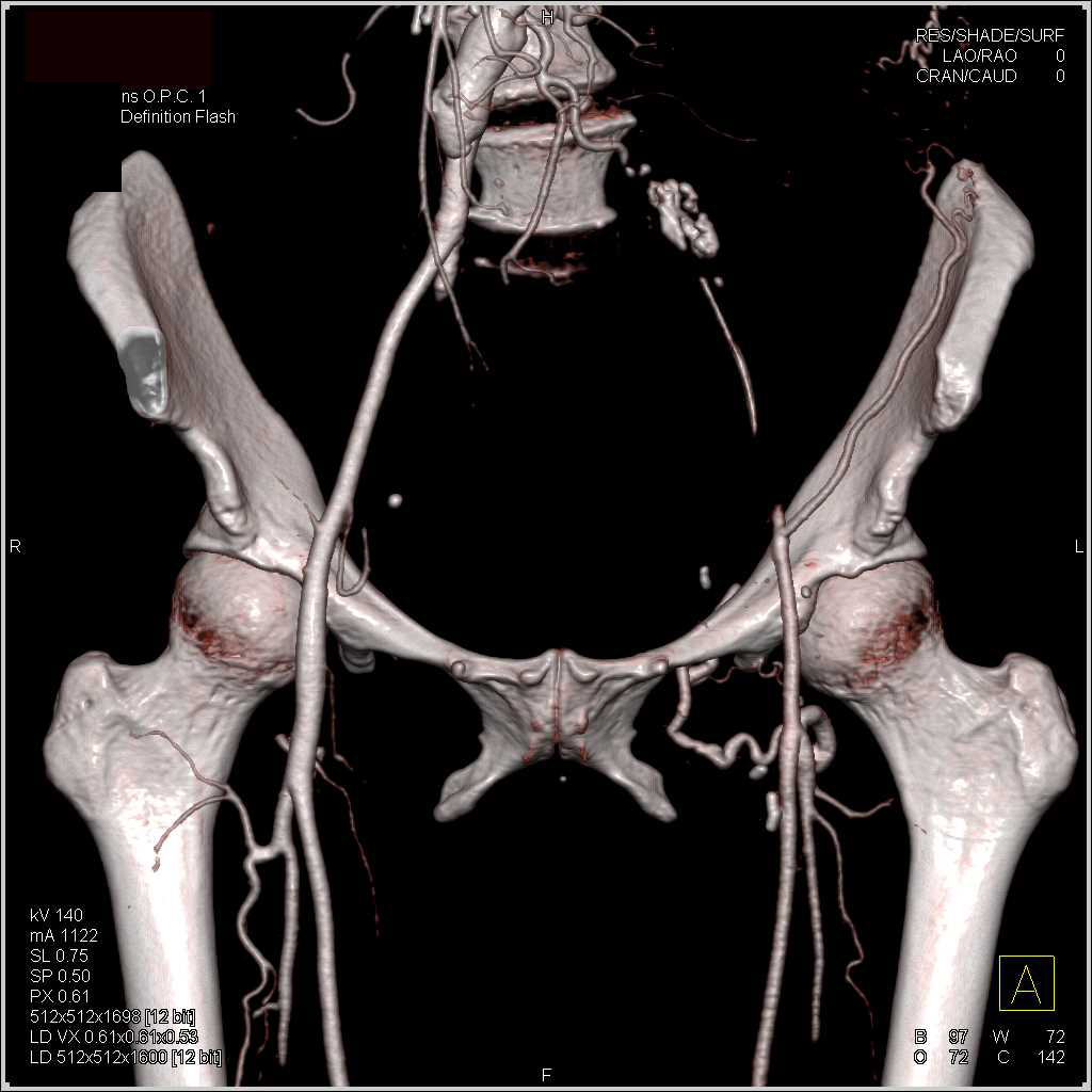 CTA with Occlusion of the Left Common Iliac Artery - CTisus CT Scan