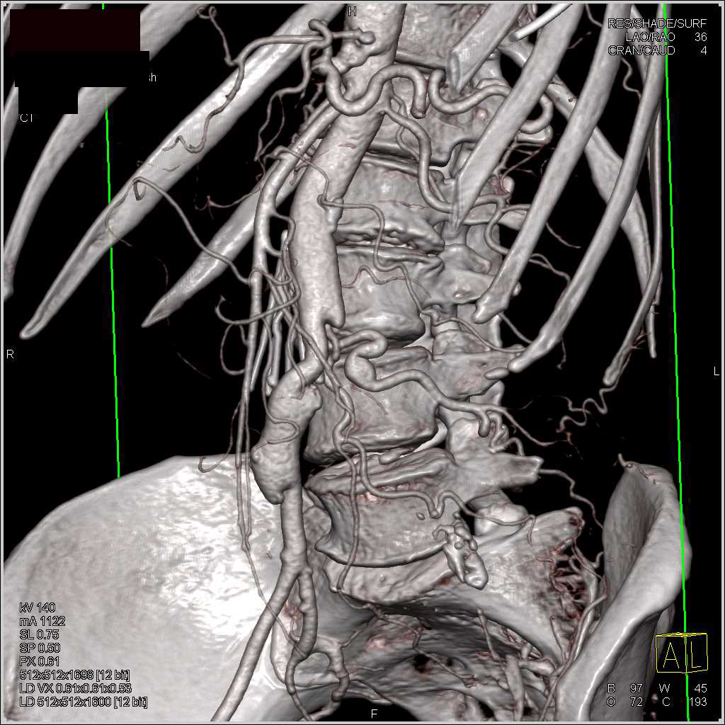 CTA with 3D Map of Occluded Left Iliac Artery with Bypasses - CTisus CT Scan