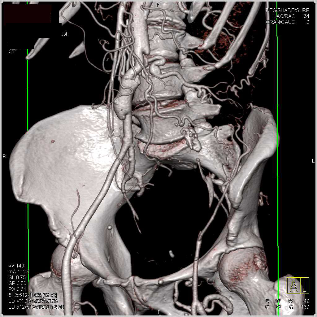 CTA with 3D Map of Occluded Left Iliac Artery with Bypasses - Vascular ...