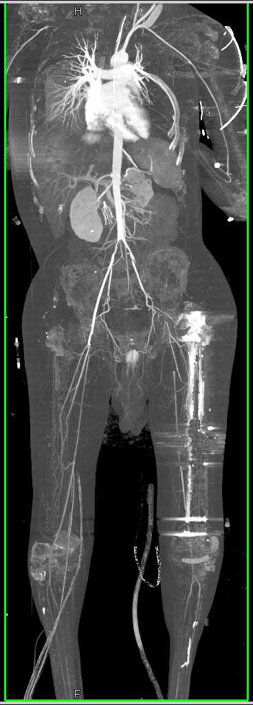 CTA with Occluded Left Superficial Femoral Artery (SFA) - CTisus CT Scan