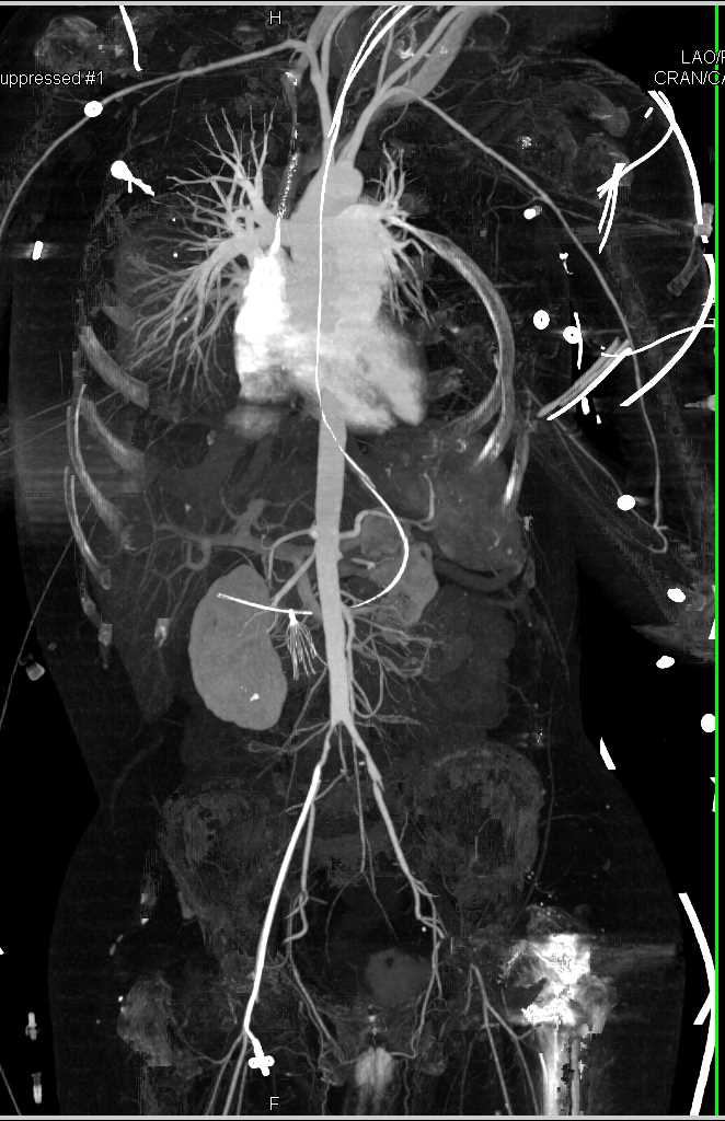 CTA with Dual Energy Bone Removal - CTisus CT Scan