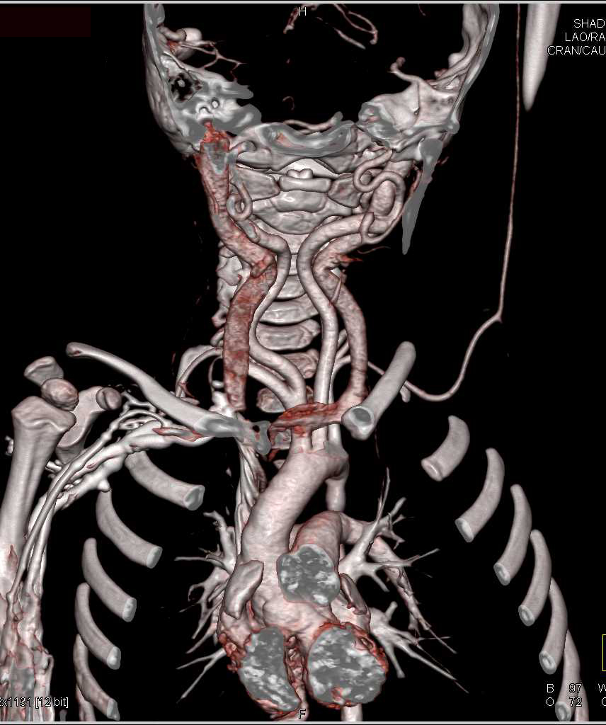 Tortuous Carotidd Arteries in a Patient with Loeys-Dietz Syndrome - CTisus CT Scan