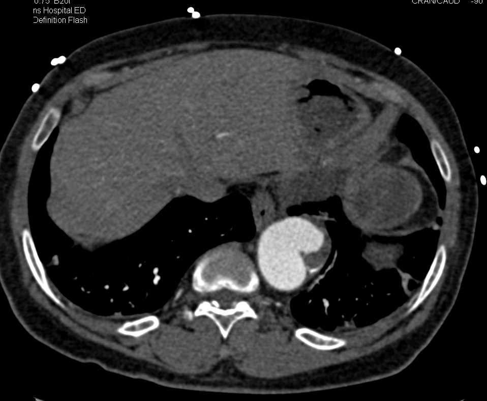 Focal Ulceration Descending Thoracic Aorta - CTisus CT Scan