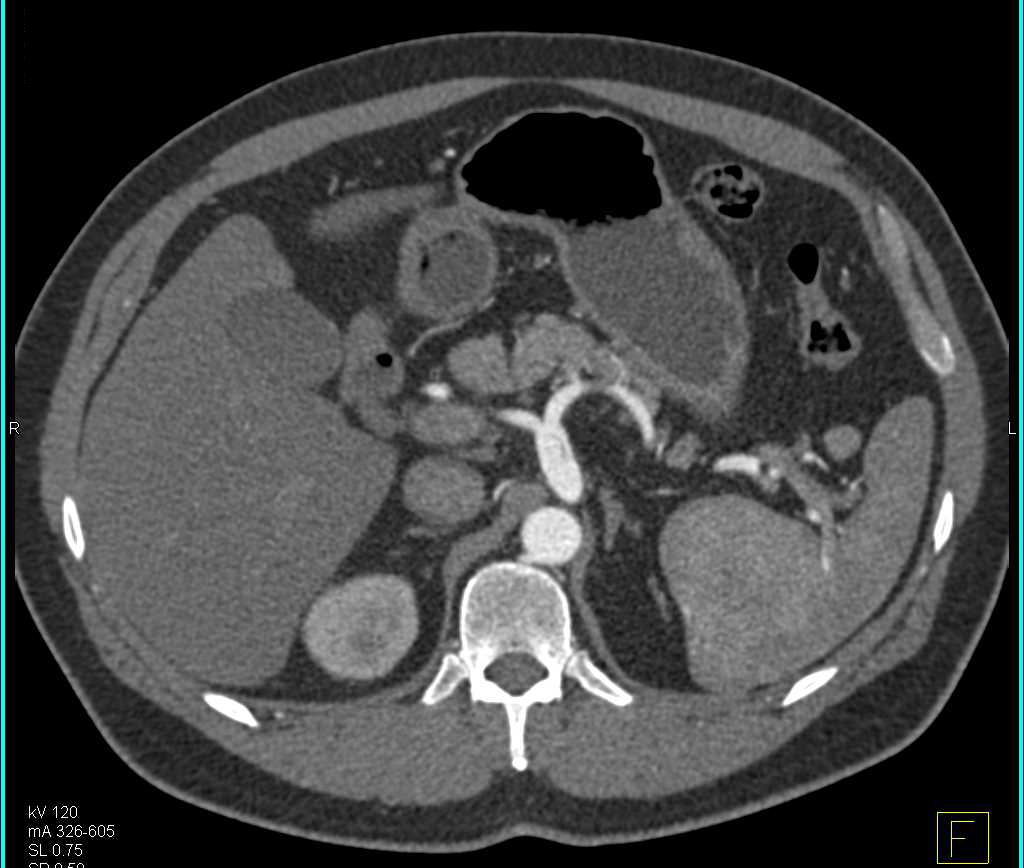 Vasculitis with Multiple Superior Mesenteric Artery (SMA) Dissections - CTisus CT Scan