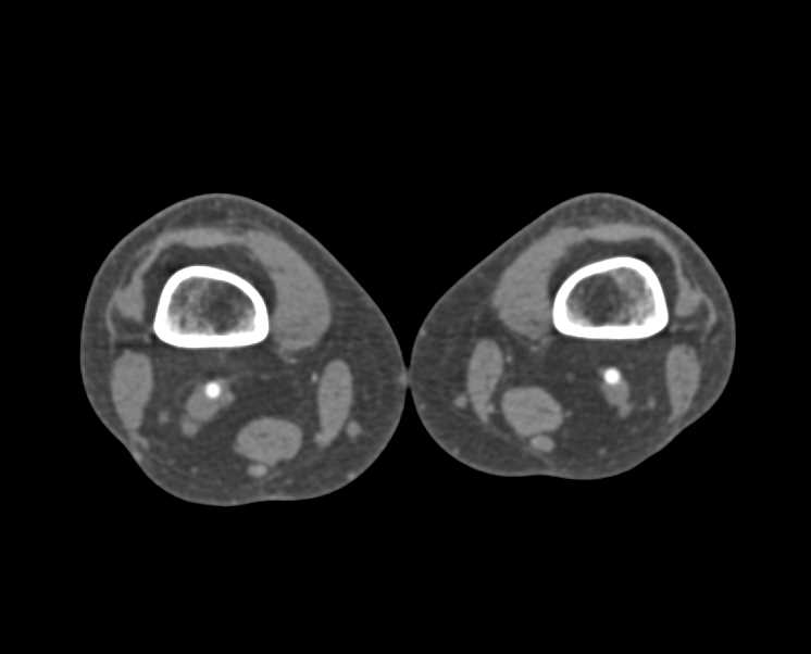 Normal CTA Runoff with DE CT - CTisus CT Scan