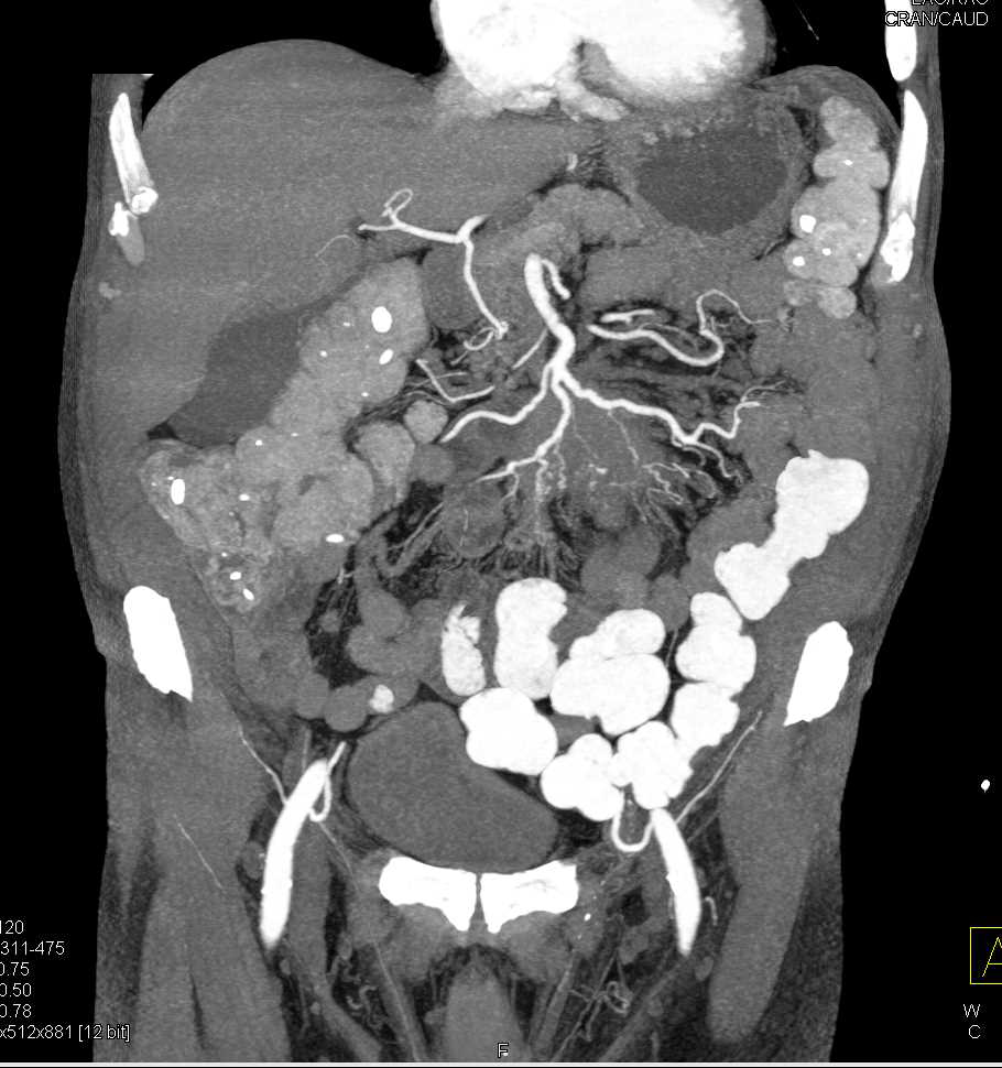 Carcinoid Tumor in Root of Mesentery Encases the Superior Mesenteric Vein (SMV) Branches - CTisus CT Scan