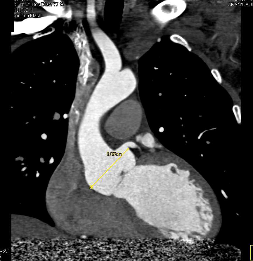 Sinus of Valsalva Aneurysm on Marfan - CTisus CT Scan