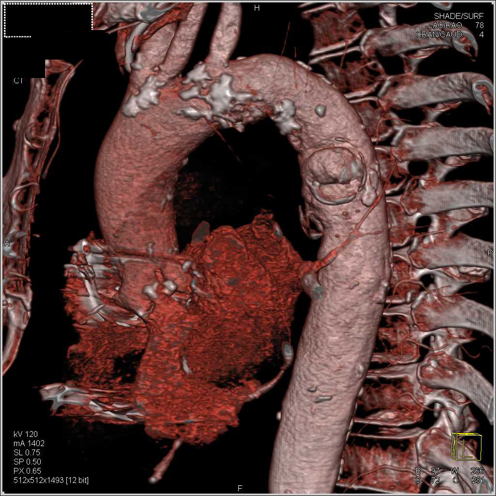 Focal Ulceration Descending Thoracic Aorta - CTisus CT Scan