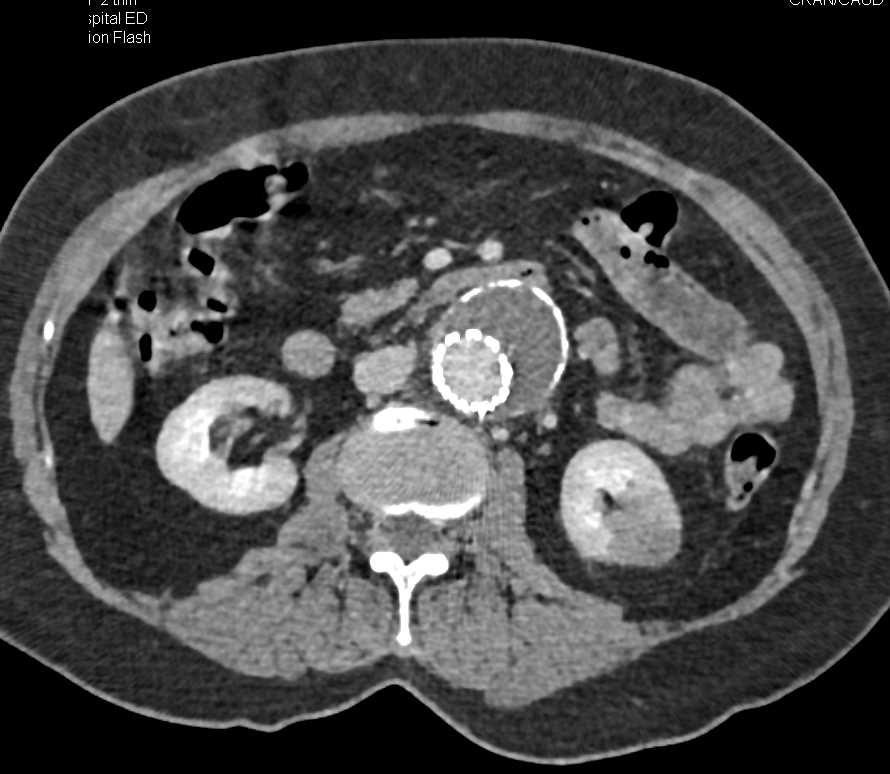 Endovascular Stent Repair of a Abdominal Aortic Aneurysm (AAA) - CTisus CT Scan