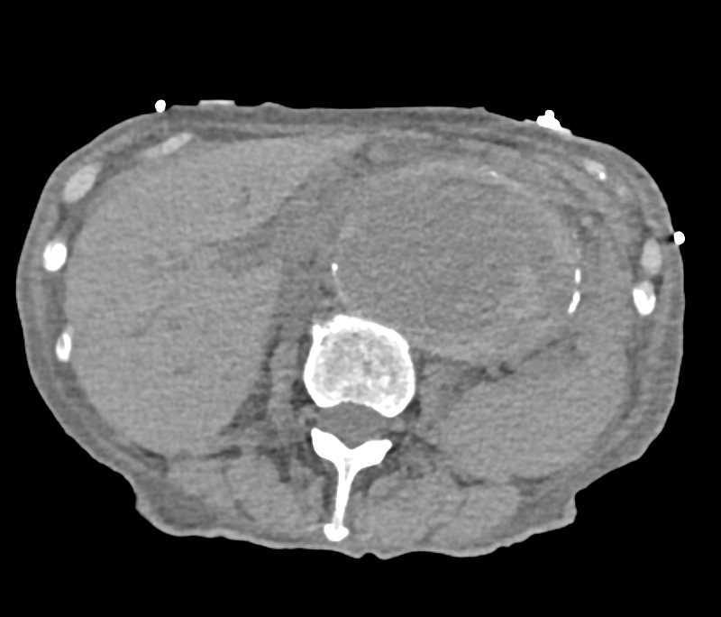 Enlarging Aortic Aneurysm with High Risk of Rupture - CTisus CT Scan