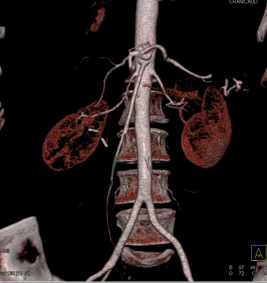 Normal Mesenteric Arteries - CTisus CT Scan