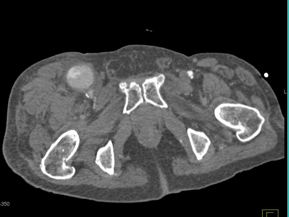 Pseudoaneurysm Right Groin - CTisus CT Scan