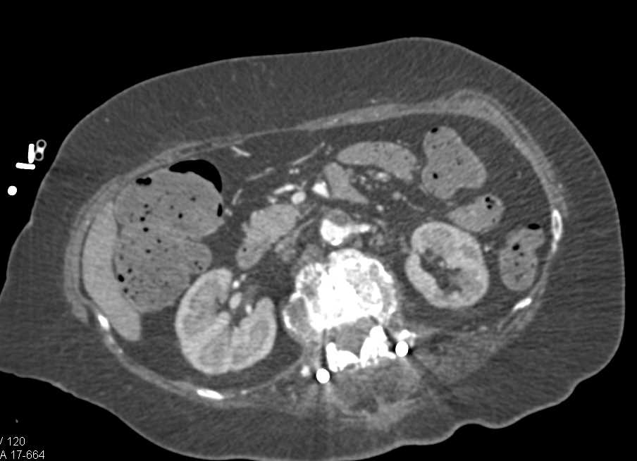 Aortic Occlusion with Collateral vessels Reconstitute the Distal Circulation - CTisus CT Scan