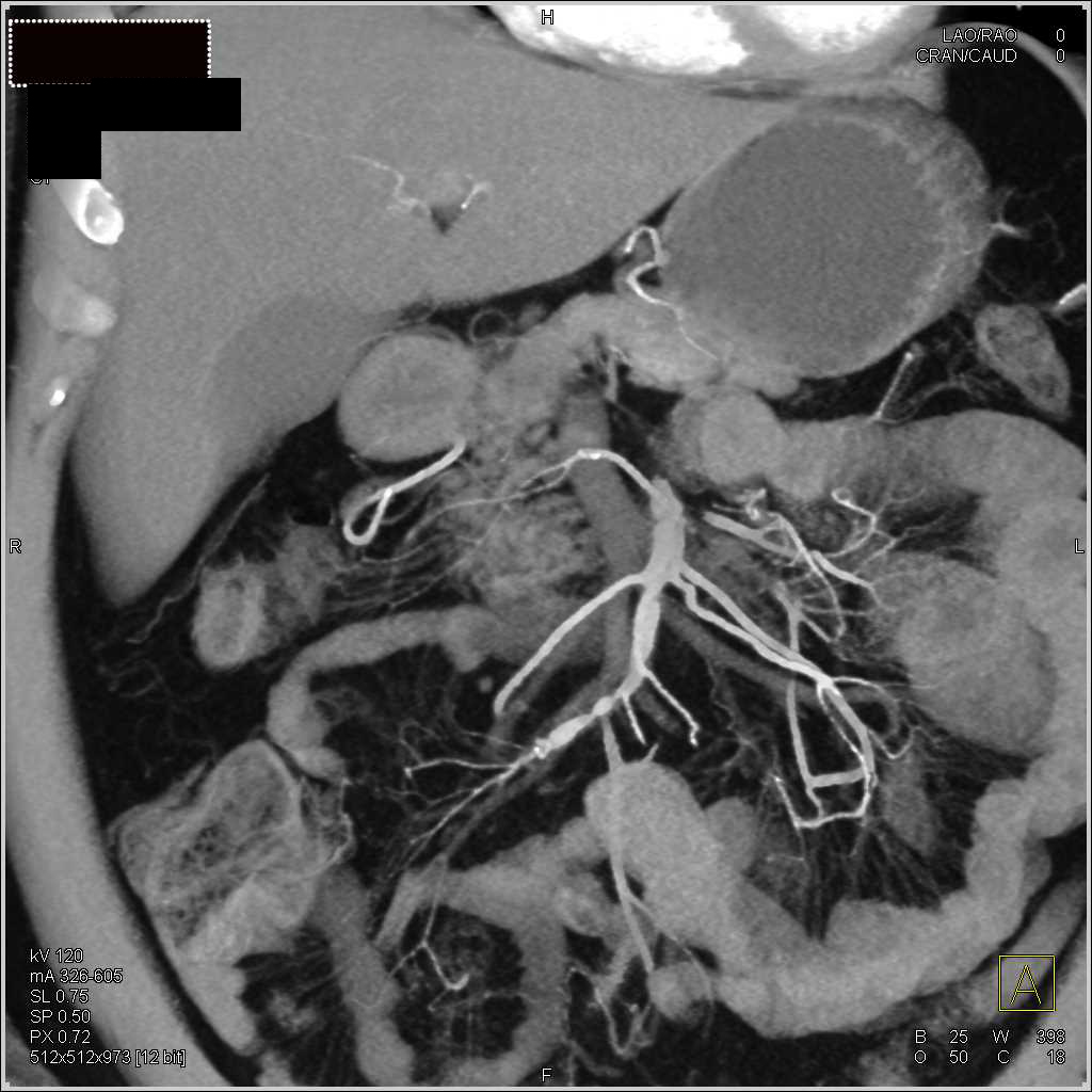 Vasculitis with Superior Mesenteric Artery (SMA) Dissections and Focal Stenosis - CTisus CT Scan