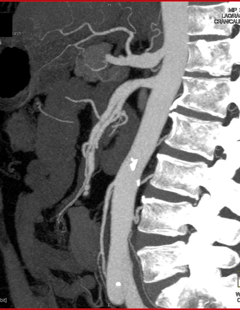 Vasculitis with Superior Mesenteric Artery (SMA) Dissections and Focal Stenosis - CTisus CT Scan