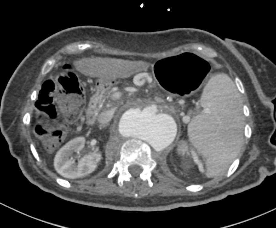 Mycotic Aortic Aneurysm with Early Spine Erosion - CTisus CT Scan