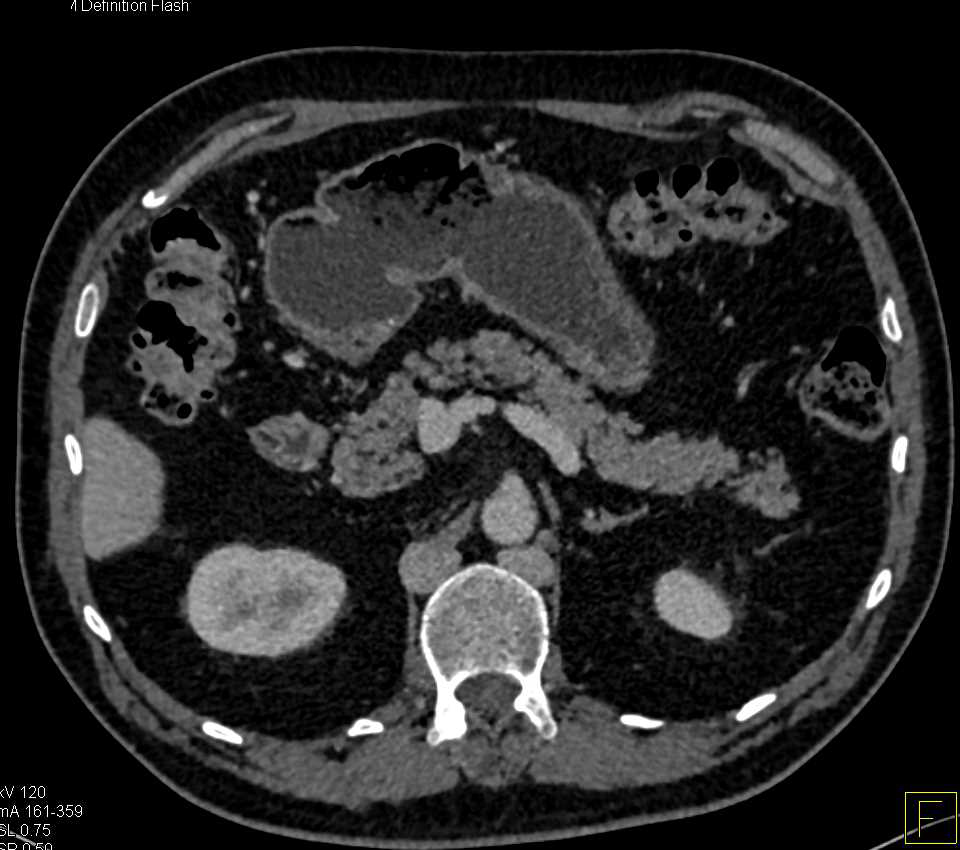 Duplicated Inferior Vena Cavas (IVCs) and Variant of Vascular Anatomy - CTisus CT Scan