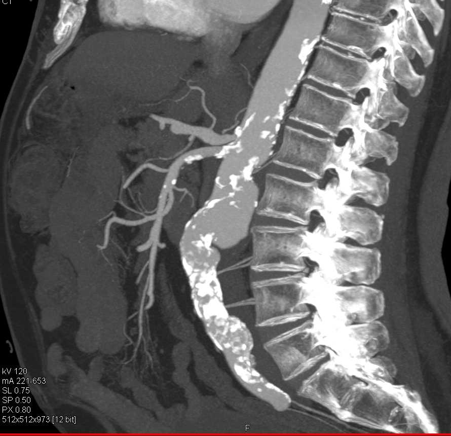 Atherosclerotic Disease Aorta and Mesenteric Vessels - CTisus CT Scan