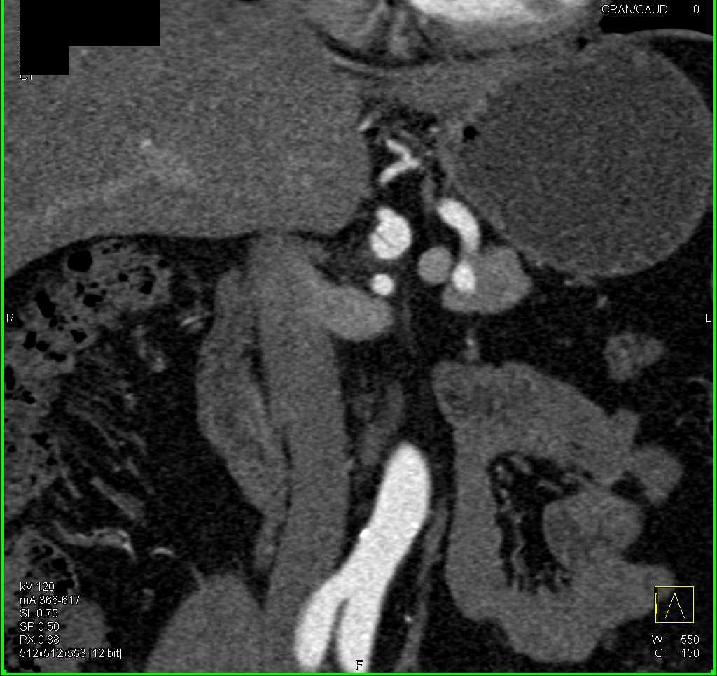 Spontaneous Celiac Artery Dissection - CTisus CT Scan