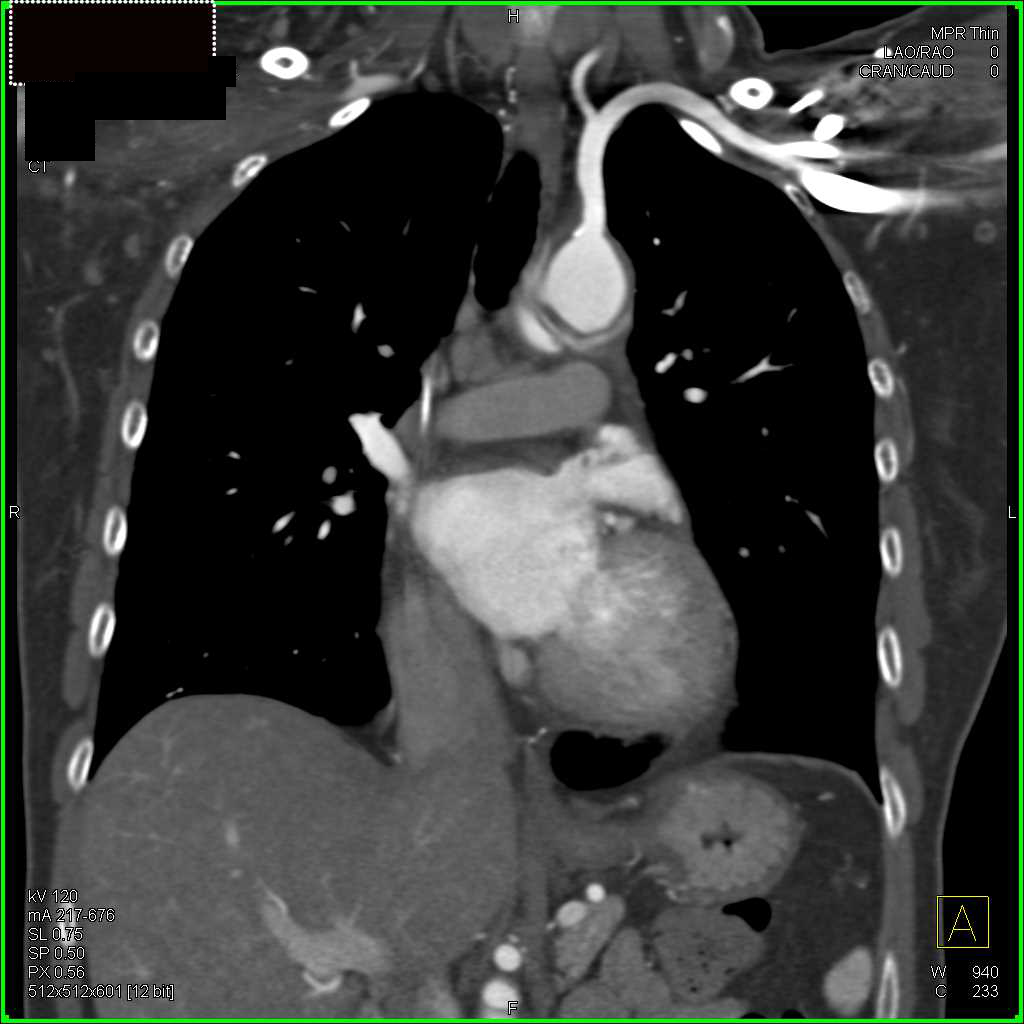 CTA with Superior Vena Cava (SVC) Stents - CTisus CT Scan