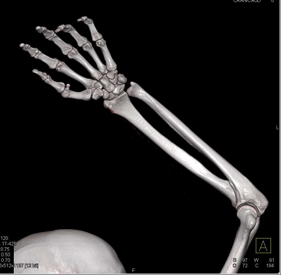 Radial Artery Pseudoaneurysm - CTisus CT Scan