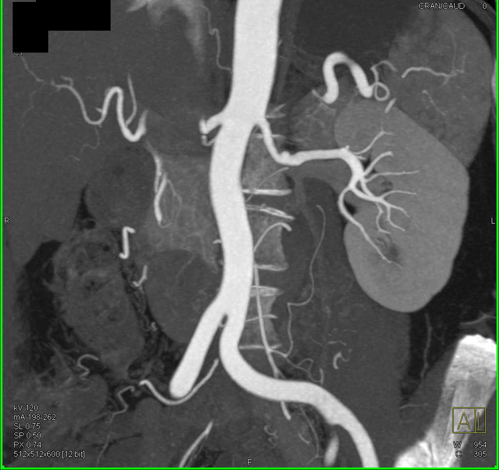 FMD (fibromuscular dysplasia) of the Renal Arteries - CTisus CT Scan