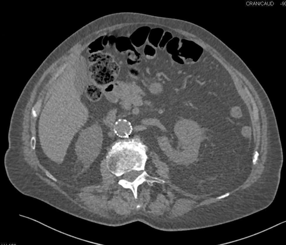 Incidental Right Renal Cell Carcinoma in Patient Evaluated with Endovascular Stent - CTisus CT Scan