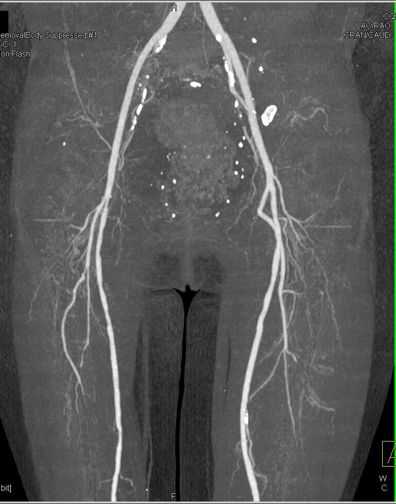 Popliteal Artery Aneurysm on Dual Energy CTA - CTisus CT Scan