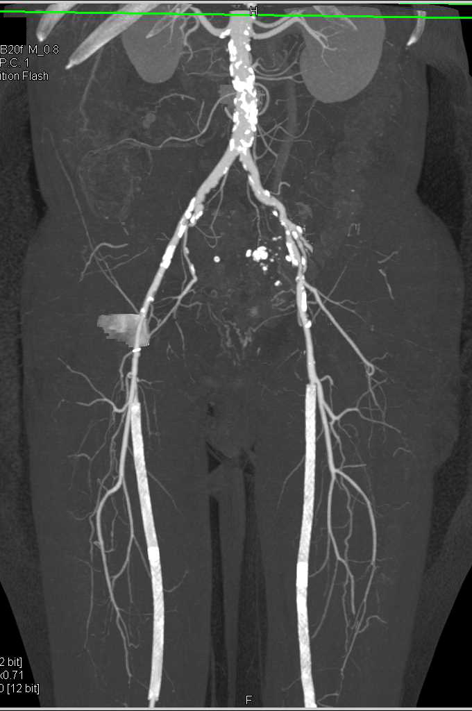 CTA with Bilateral Superficial Femoral Artery (SFA) Stents - CTisus CT Scan