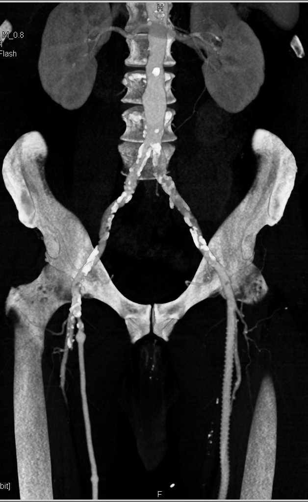 CTA with Left Superficial Femoral Artery (SFA) to Popliteal Artery Stent - CTisus CT Scan