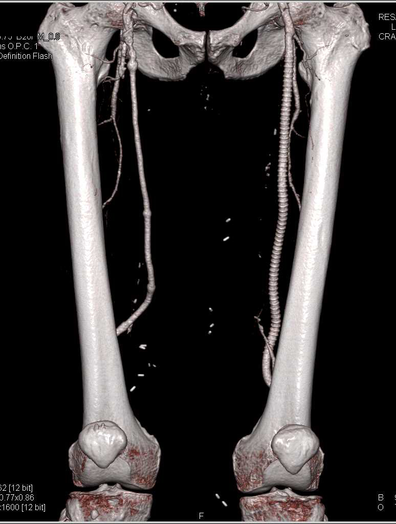 CTA with Left Superficial Femoral Artery (SFA) to Popliteal Artery Stent with Good Visualization of Trifurcation Arteries - CTisus CT Scan