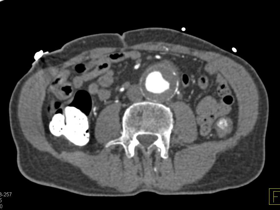 Abdominal Aortic Aneurysm with Perianeurysmal Changes - CTisus CT Scan