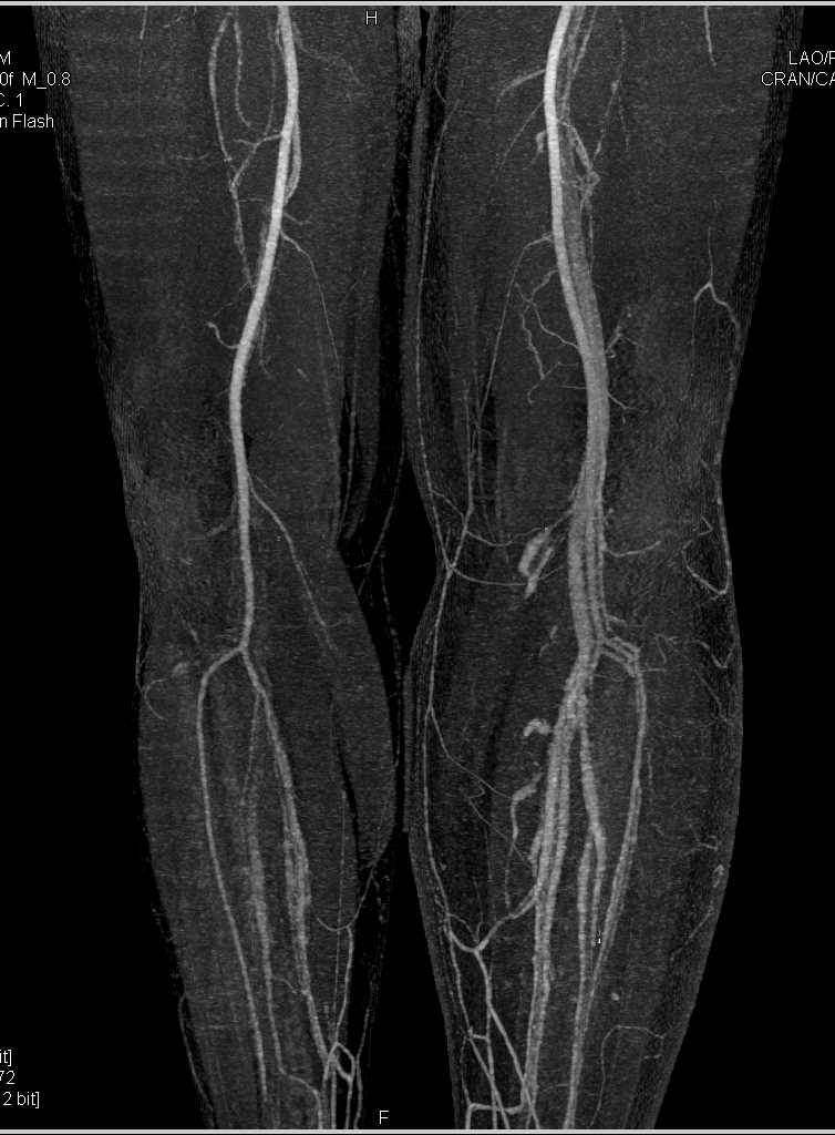 CTA DE Runoff with Early Venous Filling on Left and Cellulitis - CTisus CT Scan