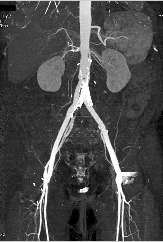 CTA with Nice Definition of Aorto-Bifemoral Grafts - CTisus CT Scan