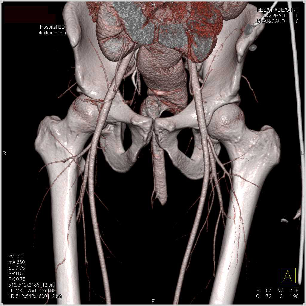 CTA S/P Trauma Without Vascular or Colon Inury - CTisus CT Scan