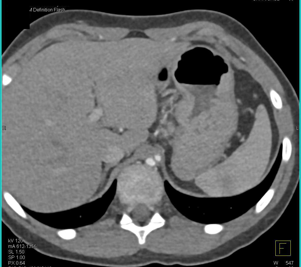 Celiac Artery Stenosis in Patient with a Prior Coarctation of the Aorta Repaired with a Stent - CTisus CT Scan