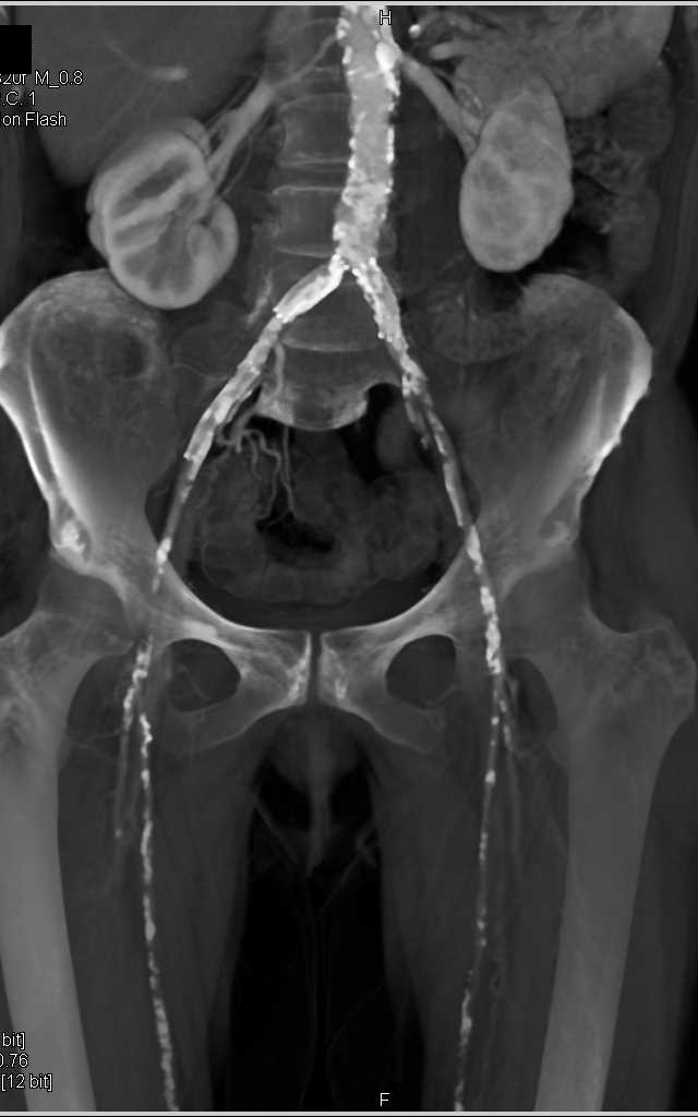 CTA Runoff with Dual Energy and Extensive Peripheral Vascular Disease with Multiple Stenosis - CTisus CT Scan