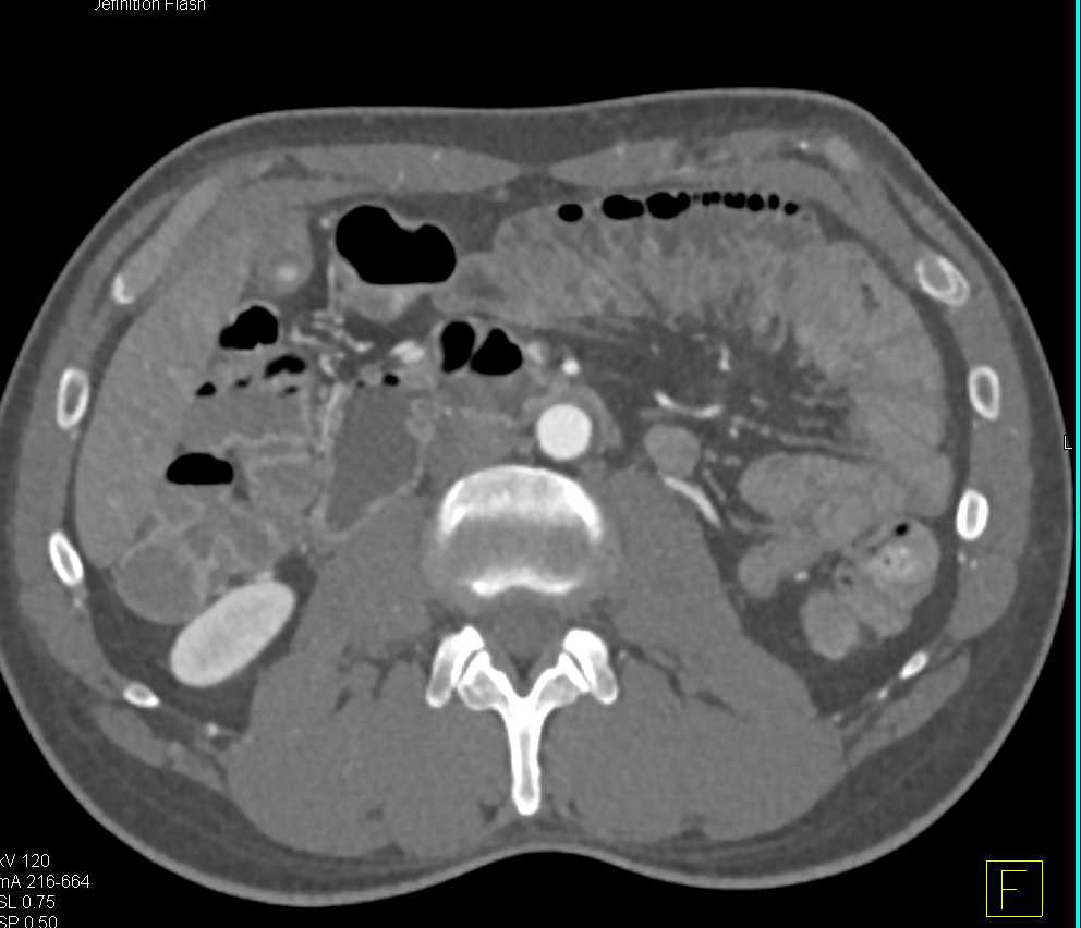 Multiple Superficial Femoral Artery (SFA) Sites of Occlusion on CTA - CTisus CT Scan