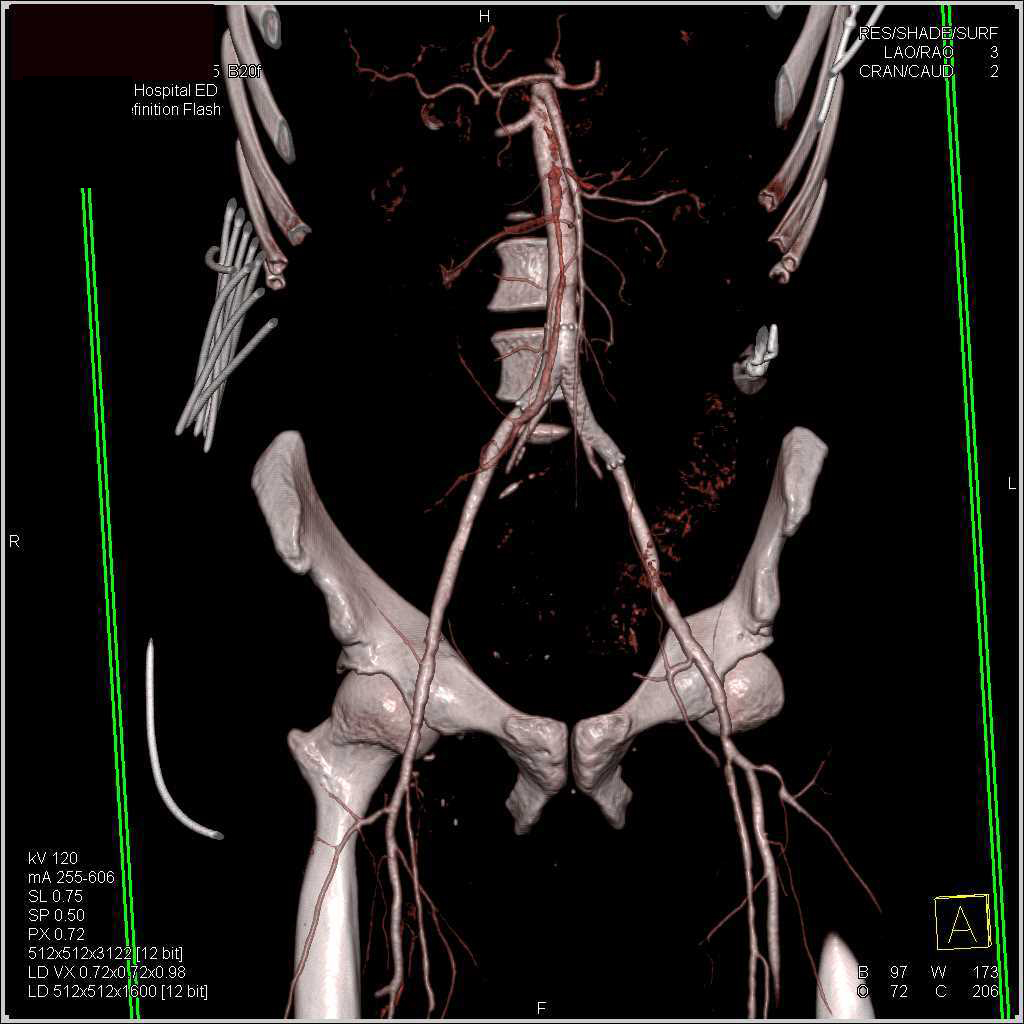 Multiple Sites of Occlusion on CTA - CTisus CT Scan