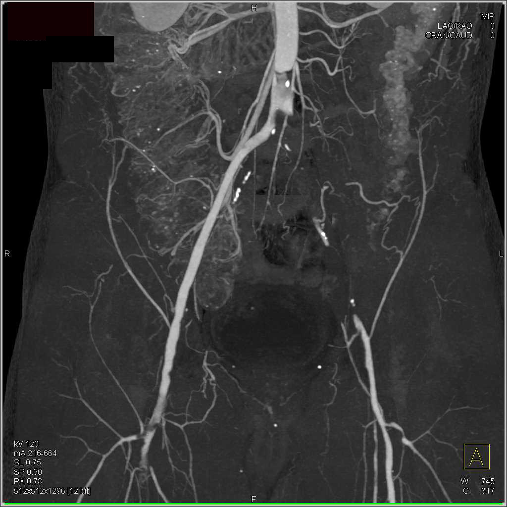 Multiple Sites of Occlusion on CTA - CTisus CT Scan