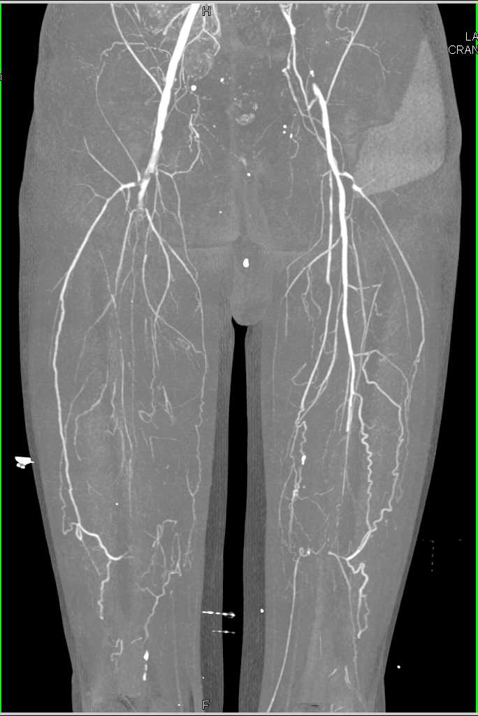 Multiple Sites of Occlusion on CTA with Dual Energy Bone Removal - CTisus CT Scan