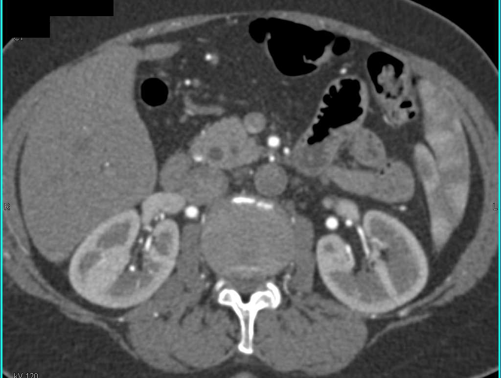 Occlusion of Aorta Beneath Renal Arteries with Extensive Collaterals - CTisus CT Scan