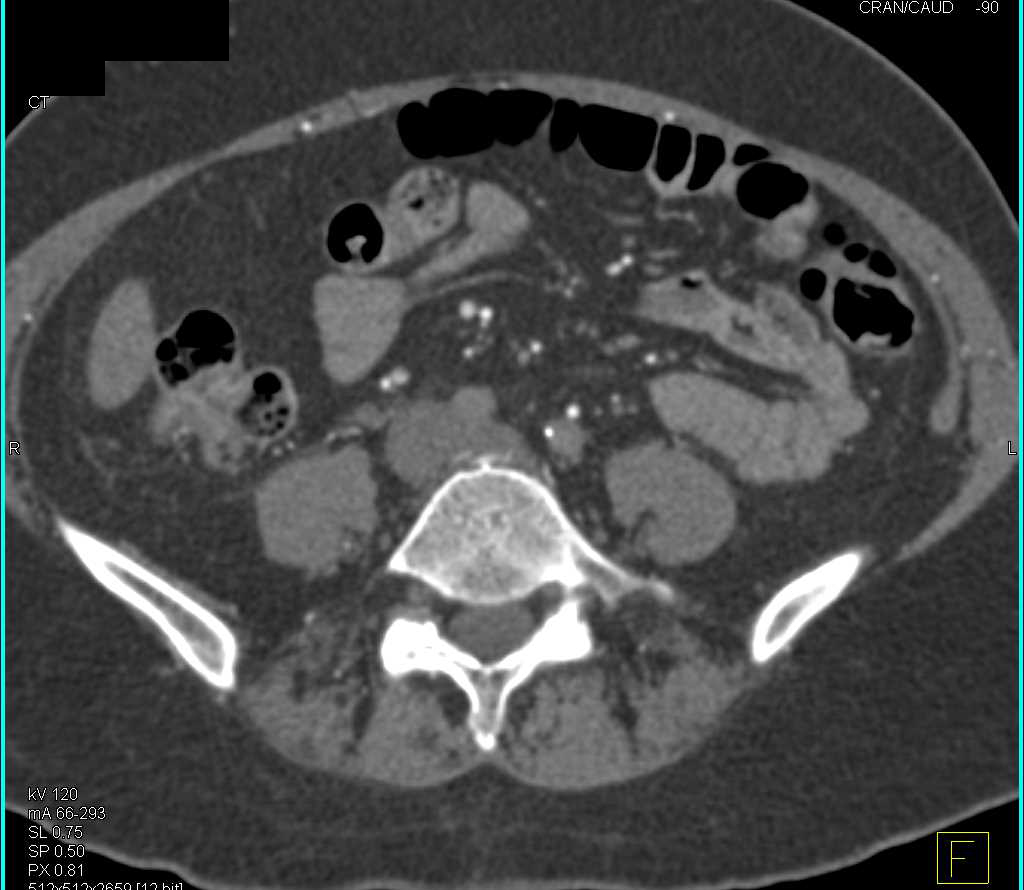 Occlusion of Aorta Beneath Renal Arteries with Extensive Collaterals - CTisus CT Scan