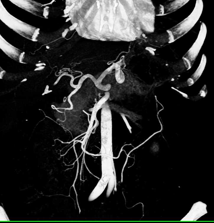 Normal 3D of Hepatic Artery - CTisus CT Scan